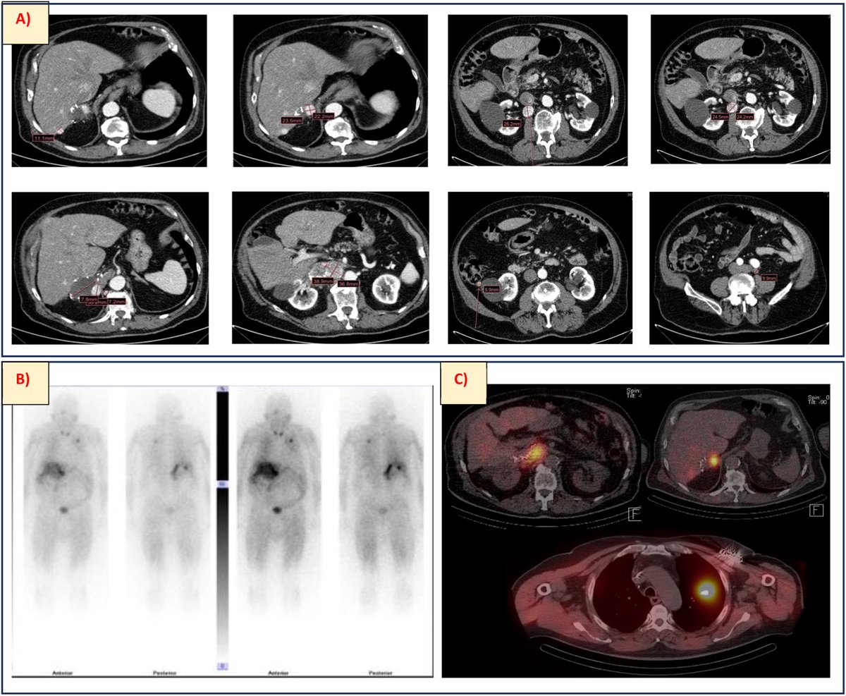 Metastatic pheochromocytoma: An unusual case and its multidisciplinary management. elsevier.es/es-revista-hip…