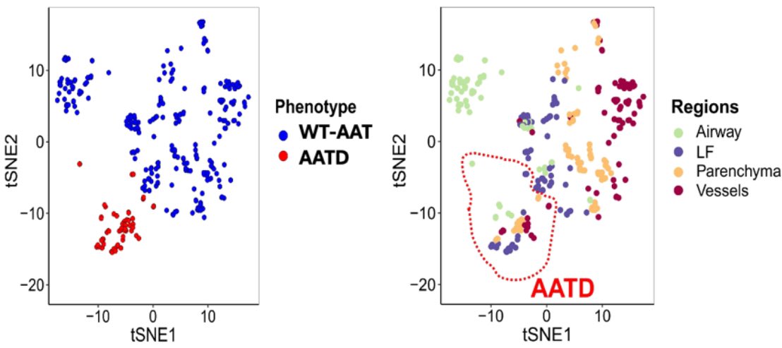 Francesca Polverino (@francypolverino) on Twitter photo Happy to share our latest work published in the ERJ <a href="/ERSpublications/">ERS publications</a> exploring the immune responses in AATD emphysema by spatial transcriptomics erj.ersjournals.com/content/early/… Happy to share our latest work published in the ERJ <a href="/ERSpublications/">ERS publications</a> exploring the immune responses in AATD emphysema by spatial transcriptomics erj.ersjournals.com/content/early/…