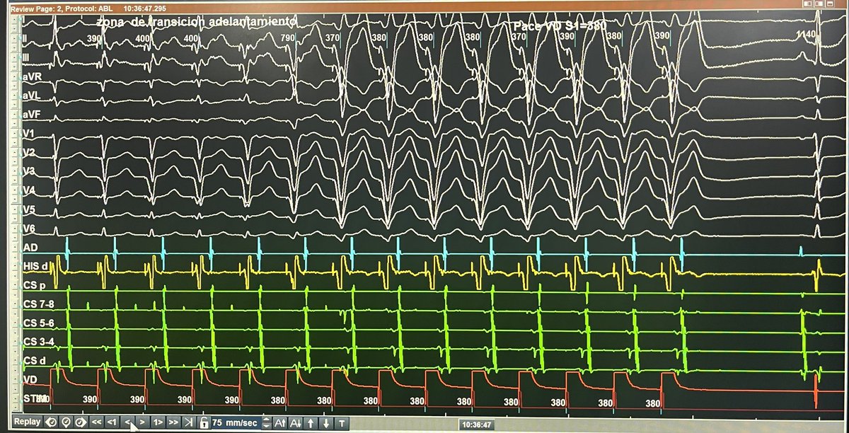 SVT in the lab.
Unable to entrain.
Can you tell a diagnosis ?
Let’s try #fellowsfirst

<a href="/Koichi16423232/">Koichi Nagashima@EP Univ. Ablation School</a> <a href="/GusCostaEP57/">Gustavo Costa</a> 

<a href="/hospital/">Hospital</a> posadas