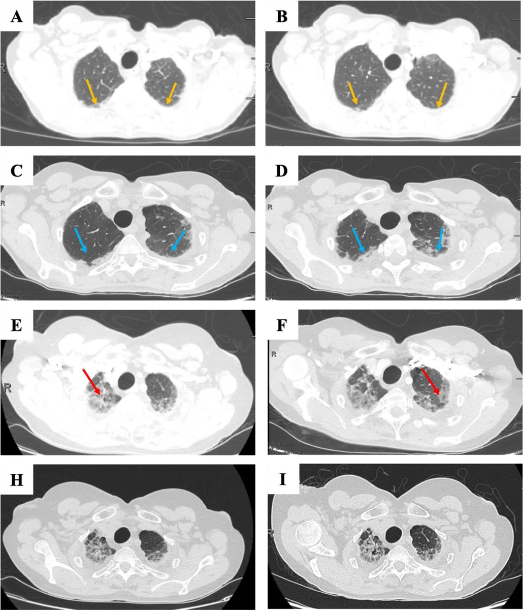 Pleuroparenchymal fibroelastosis. elsevier.es/es-revista-med…