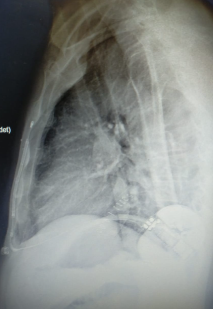 🧵10/10

Y hasta aquí este REPASO INFORMAL al DAI SUBCUTÁNEO (SC-ICD) con especial énfasis a su seguridad

Cualquier duda, experiencia, ruego... coméntanos! #aprendemosjuntos

P.D. aquí nuestro último implante para presumir del trabajo en equipo😌
#ubuntu
#somoscardiodelnegrin