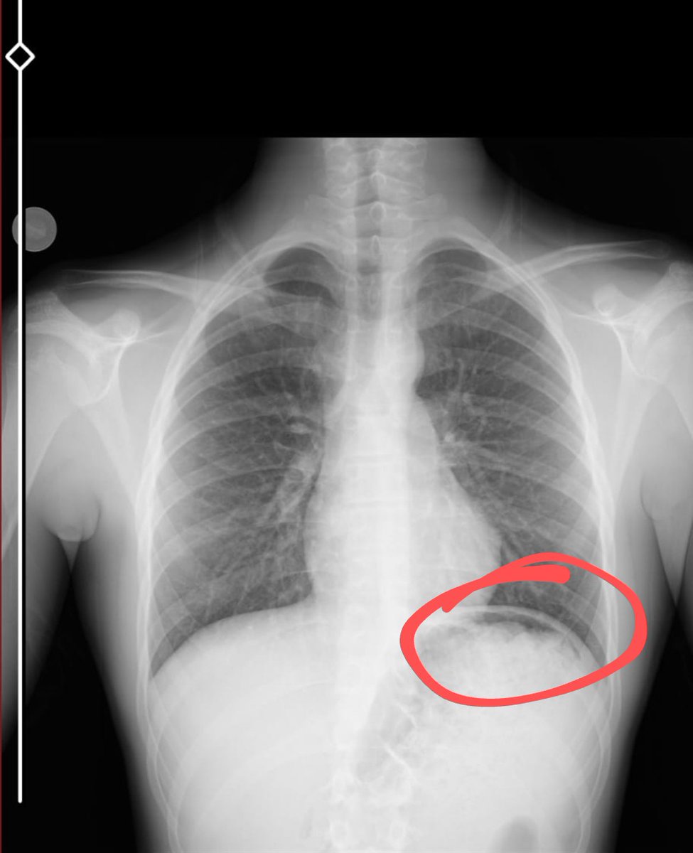 Barsaklar diyafram kası üzerine interpoze olunca buna Chiiladiti bulgusu deniyor.
Gaz sıkışması 

Bizim oğlanın filmi
Korktuk işte
Ana babalık