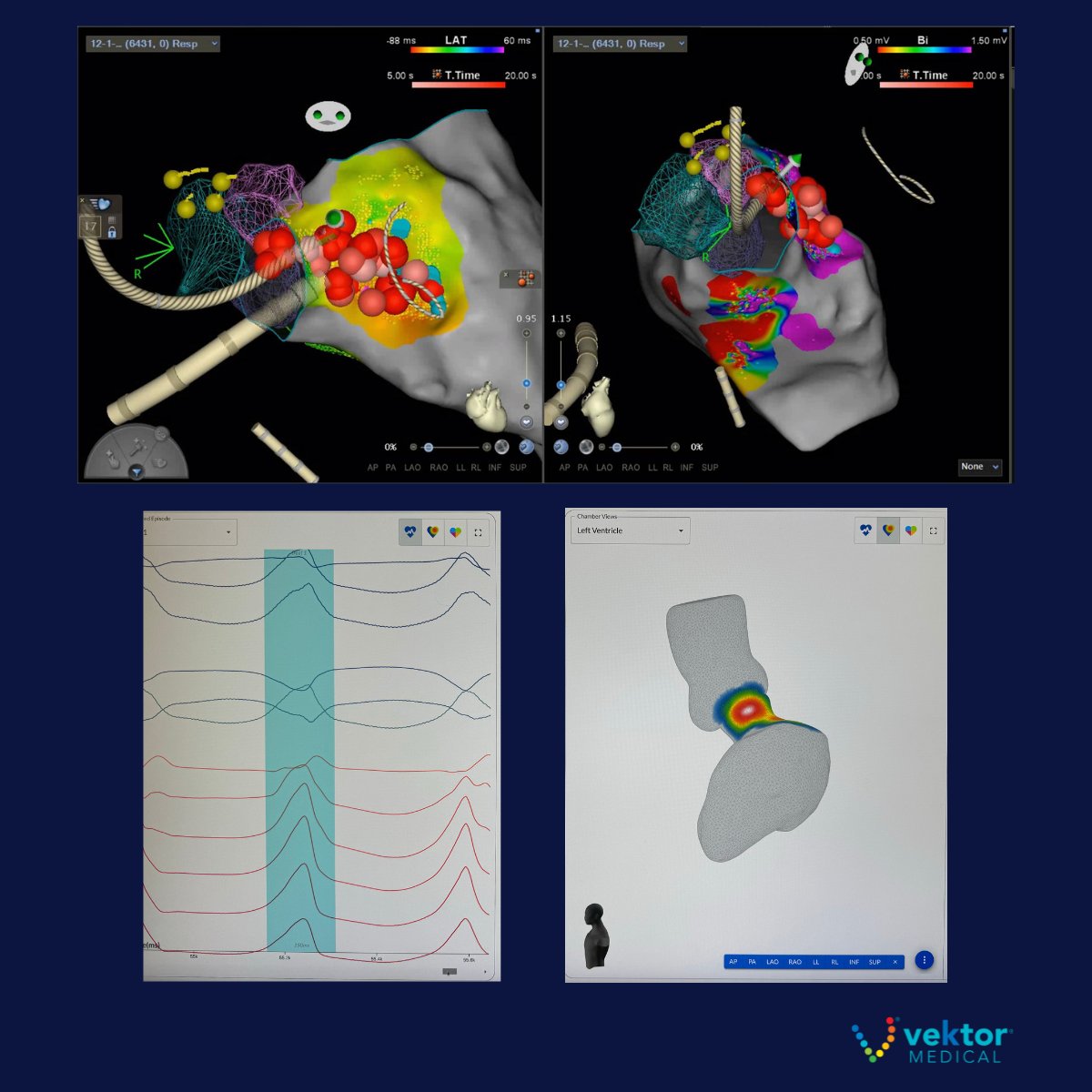 VektorMedical's tweet image. 🫀Clinical Case with Dr. Gordon Ho, UCSD:  Male patient, 70-79 years old, with EF at 40%, presented for VT ablation. Since July, the patient has had 7 VT events with subsequent ICD shocks.

Details ⬇️

#epeeps #cardiology #EPLab #VT