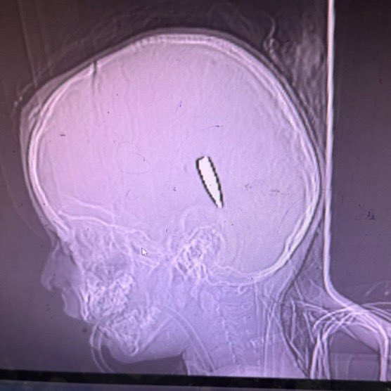NourNaim88's tweet image. 🚨HORRIBLE: X-rays from Naser Hospital in Khan Yonis southern #Gaza show Israeli forces directly targeting Palestinian children in the head, killing them instantly. This horrific crime, confirmed by Dr. Mimi Sidd, highlights the brutality of these attacks.

Source: New York Times