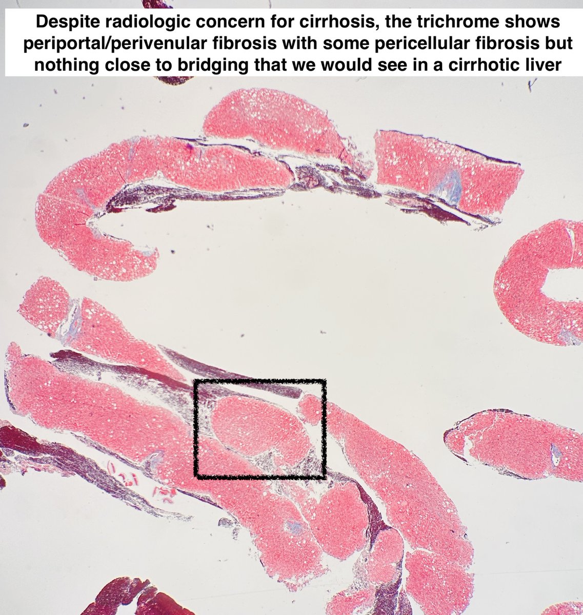 Path4People's tweet photo. #pathtip 

📖Nodular Regenerative Hyperplasia

🩺Pt w signs of portal HTN (splenomegaly, esophageal varices, ascites) 
🩻Imaging looks like cirrhosis
🔬But Trichrome shows no cirrhosis
🎨Reticulin network compressed b/n nodules
📖Many causes but➡️portal hepatic🩸flow abnormality https://t.co/TJacPEzQFm