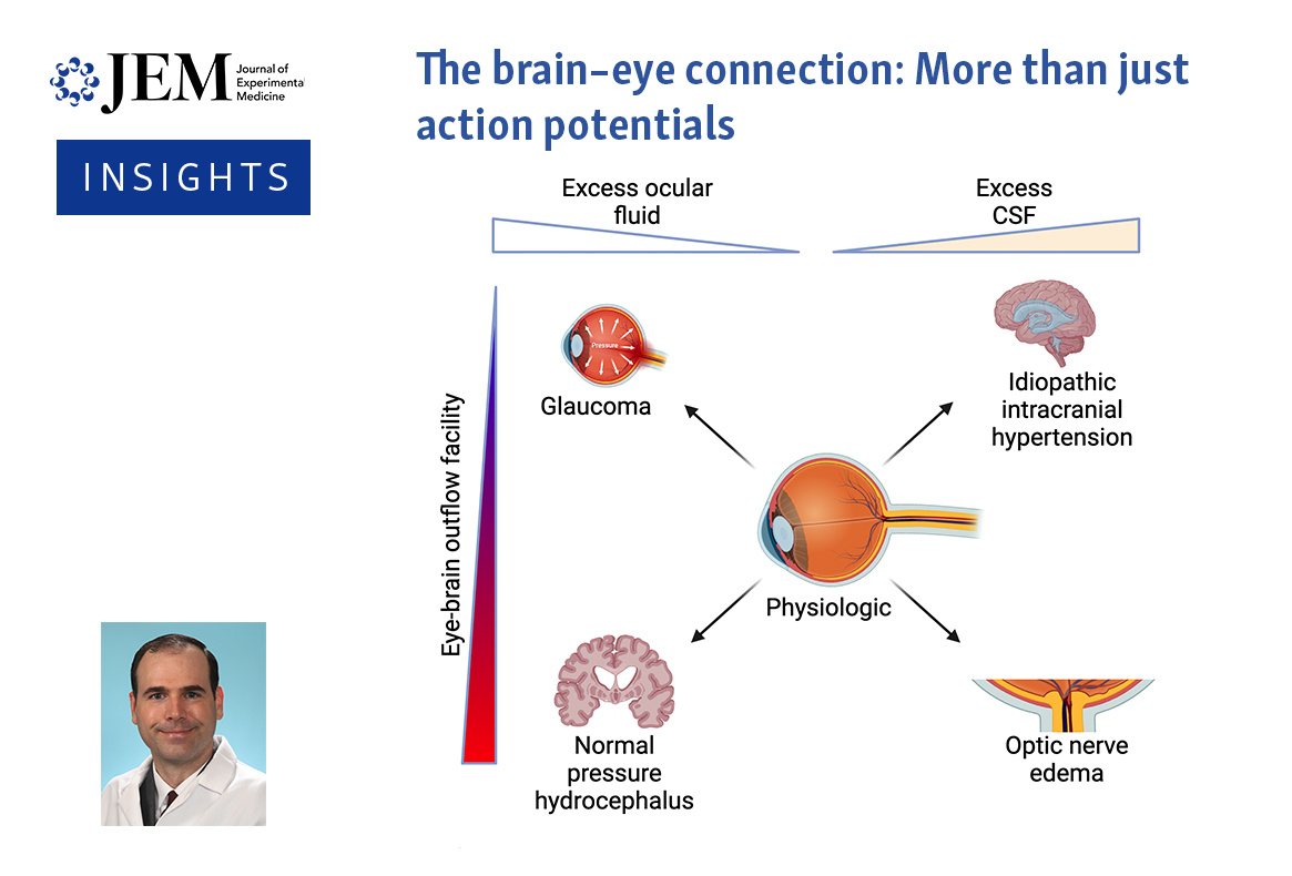 Insights: James Walsh @WashUDOVS discusses study from Cao et al. (hubs.la/Q02SYpQw0) which demonstrates that, in #Alzheimers disease (AD), the influx of toxic Aβ from the brain to the retina underlies AD-induced retinal degeneration. hubs.la/Q02SY0Xg0
#Neuroscience