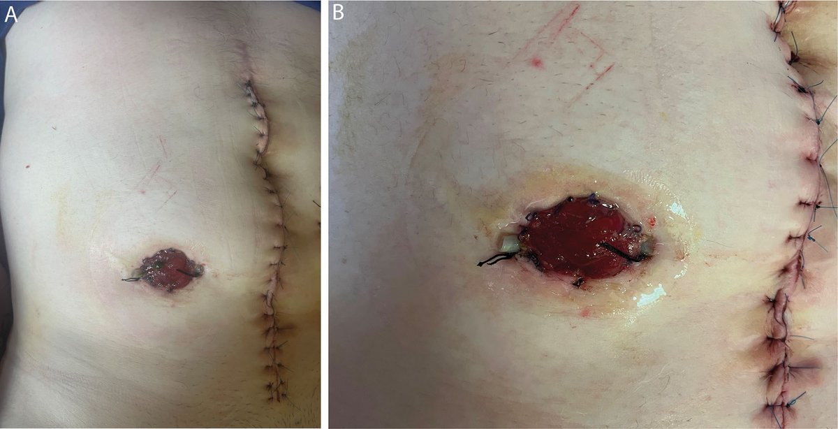 DCRjournal (@dcrjournal) on Twitter photo Nail polish as an ostomy baseplate? A clinical trial demonstrating new and economical use of a common cosmetic product. Read more in this month's #DCRJournal: bit.ly/3Xhy0L0
<a href="/ConorDelaneyMD/">Conor Delaney</a> <a href="/justinmaykel/">Justin Maykel</a> <a href="/dubaicolorectal/">Maher A. Abbas, MD, FACS, FASCRS, FPSCRS-Honorary</a> <a href="/SamAtallahMD/">Sam Atallah, MD</a> <a href="/debby_keller/">Debby Keller, MD</a> <a href="/SeanLangenfeld/">Sean Langenfeld</a> Nail polish as an ostomy baseplate? A clinical trial demonstrating new and economical use of a common cosmetic product. Read more in this month's #DCRJournal: bit.ly/3Xhy0L0
<a href="/ConorDelaneyMD/">Conor Delaney</a> <a href="/justinmaykel/">Justin Maykel</a> <a href="/dubaicolorectal/">Maher A. Abbas, MD, FACS, FASCRS, FPSCRS-Honorary</a> <a href="/SamAtallahMD/">Sam Atallah, MD</a> <a href="/debby_keller/">Debby Keller, MD</a> <a href="/SeanLangenfeld/">Sean Langenfeld</a>