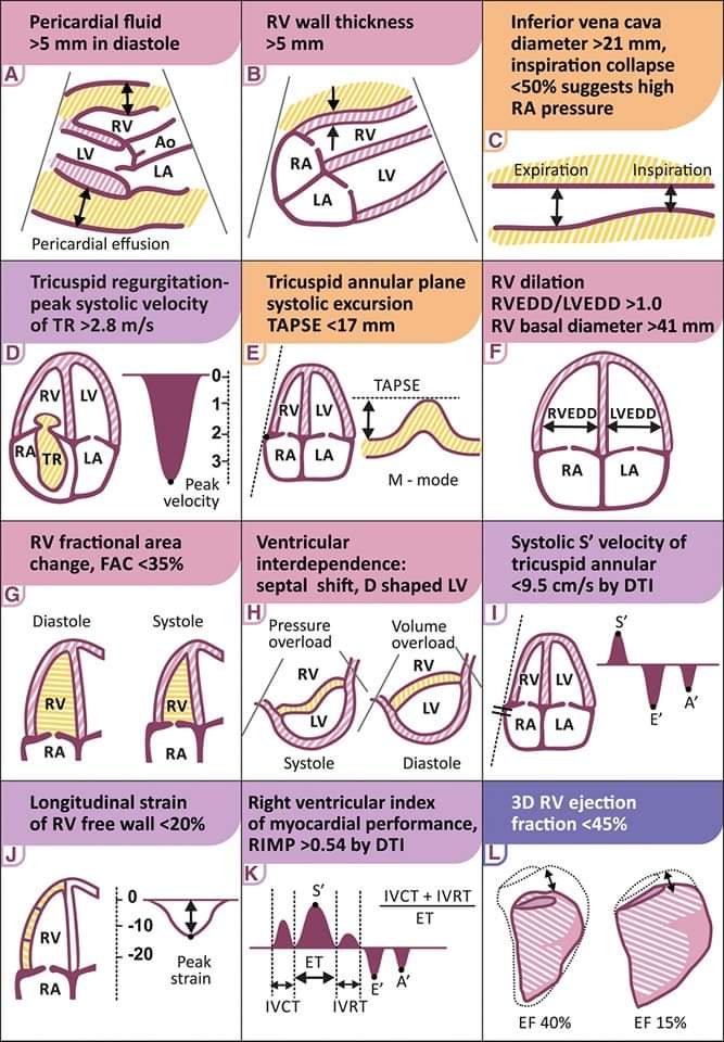 🔴Right ventricular function:  Echocardiographic Evaluation ⤵️♥️  

🔹onlinelibrary.wiley.com/doi/full/10.10…
#Diagnosis #Cardiology #POCUS #Echocardiogram #RightVentricle #RightVentricular #RVDysfunction #Measurements #Criteria
 #Cardiology #FOAMed #MedEd #medstudent #paramedic #Cardiology