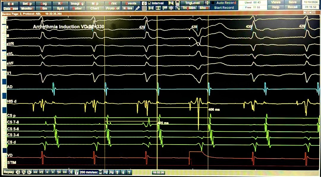 <a href="/MASA02460147/">MASA</a> <a href="/Koichi16423232/">Koichi Nagashima@EP Univ. Ablation School</a> <a href="/GusCostaEP57/">Gustavo Costa</a> <a href="/hospital/">Hospital</a> Anyway, a single HRPVC can make the diagnosis.