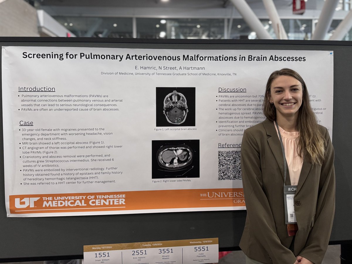UTK_PCCM's tweet image. Solid @utgsm IM resident presentations at @accpchest #CHEST2024
Dr Christy Smith
Poster 5494- “HYPEREOSINOPHILIA: A PECULIAR PARANEOPLASTIC PROCESS OF LUNG ADENOCARCINOMA”
Dr Erin Hamric
“Poster 2551- “SCREENING FOR PULMONARY ARTERIOVENOUS MALFORMATIONS IN BRAIN ABSCESSES”