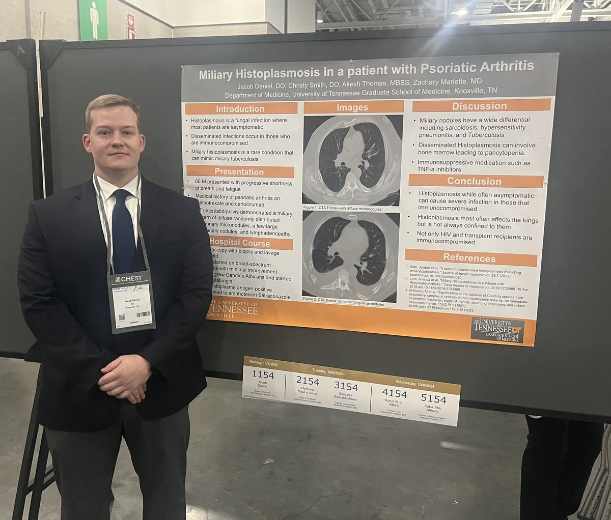UTK_PCCM's tweet image. Solid @utgsm Internal Medicine resident presentations at @accpchest #CHEST2024
Dr Jacob Daniel
Poster 1154- MILIARY HISTOPLASMOSIS IN A PATIENT WITH PSORIATIC ARTHRITIS
Dr Jesse Woodall
Poster 5320- PREVENTING THE INEVITABLE: EVIDENCE FOR POST-TIPS PROPHYLAXIS
Great job!