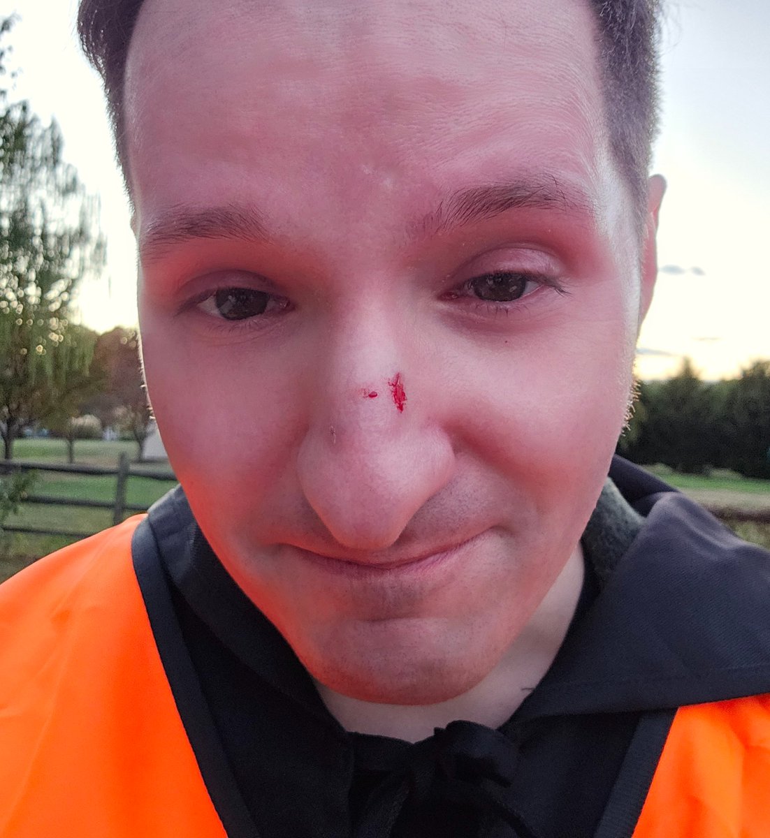 SchlockAweFilms's tweet photo. Bruised and bloody after @FallonVendetta hit me with a book in our fight scene #stunts #filmm https://t.co/6X8wnmJQzx
