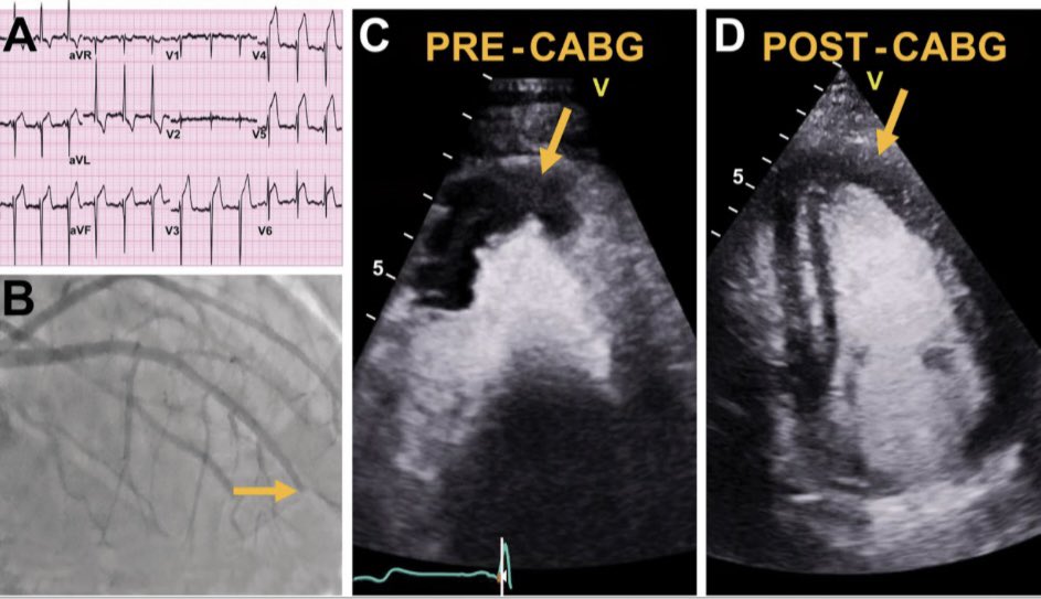 Ben (@benwordell1) on Twitter photo Proud to share our case image in the Journal of Echocardiography, highlighting
'Echocardiographic revelations in acute myocardial infarction'. Read here: rdcu.be/dWknt
<a href="/PWesslyMD/">Priscilla Wessly</a> <a href="/renujain19/">Renu</a> <a href="/tonganfor/">Tonga Nfor</a>
#AuroraStLukes Proud to share our case image in the Journal of Echocardiography, highlighting
'Echocardiographic revelations in acute myocardial infarction'. Read here: rdcu.be/dWknt
<a href="/PWesslyMD/">Priscilla Wessly</a> <a href="/renujain19/">Renu</a> <a href="/tonganfor/">Tonga Nfor</a>
#AuroraStLukes