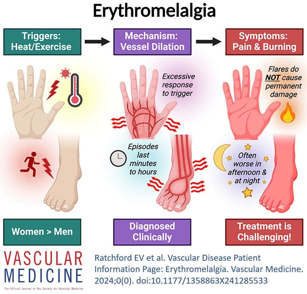 Erythromelalgia is rare and can be challenging to diagnose and manage. In our latest #free Patient Information Page, <a href="/evratchford/">Elizabeth Ratchford</a> <a href="/PagingDrSolomon/">Alexandra Lauren</a> and Dr. Davis provide an excellent summary for patients and providers. 
<a href="/Erythromelalgia/">Erythromelalgia Awareness</a> <a href="/EM_Warriors/">Erythromelalgia Warriors</a>