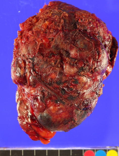 EricMadPatho's tweet photo. 69M with history of right 2nd finger amputation 3yrs ago. Huge 10cm right axillary LN mets, post palliative dissection. Planning PORT and immunotherapy. Gross and low power of the axillary metastatic melanoma. Last pic of punch biopsy where tumor originated. https://t.co/vGyVigS1bs