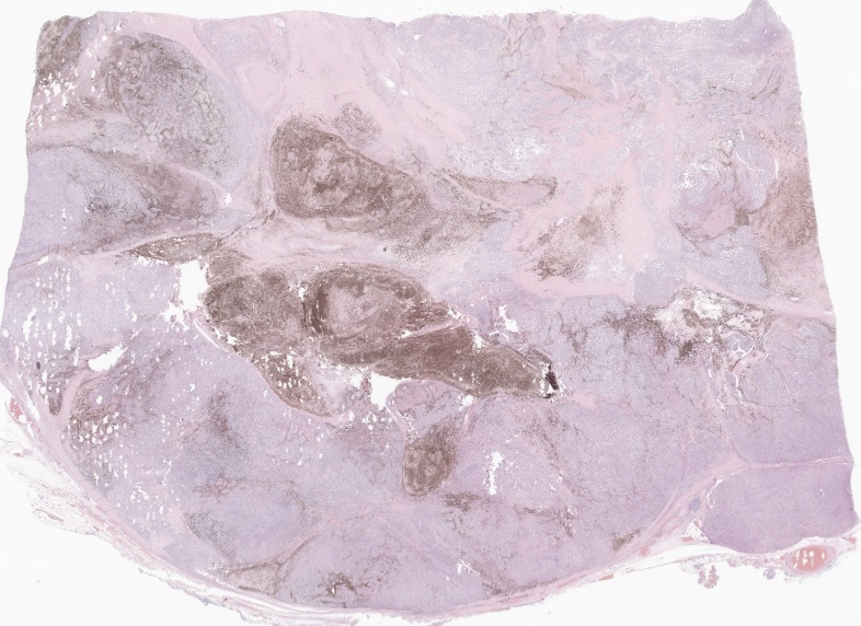 EricMadPatho's tweet photo. 69M with history of right 2nd finger amputation 3yrs ago. Huge 10cm right axillary LN mets, post palliative dissection. Planning PORT and immunotherapy. Gross and low power of the axillary metastatic melanoma. Last pic of punch biopsy where tumor originated. https://t.co/vGyVigS1bs