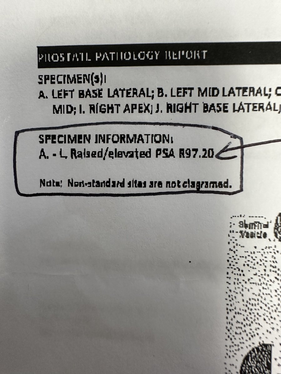 if you’re seeing PSA level “97.20 ng/ml” somewhere on pros bx path report, its likely wrong

97.20 is the ICD code for elevated PSA

I’ve seen this error often!  Mistake gets passed along patient chart! May not be a false neg bx that didn’t correlate!

example here👇🏽