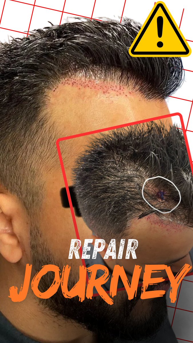 BHRClinic's tweet photo. https://t.co/EZAiCXwh84

Repairing Hair Transplants..Anyone can break an egg, un-breaking it is the hard part. 

This patient is documenting his repair journey with us. #bhrclinic #hairtransplantrepair #hairtransplants https://t.co/EfABKDr8Kd
