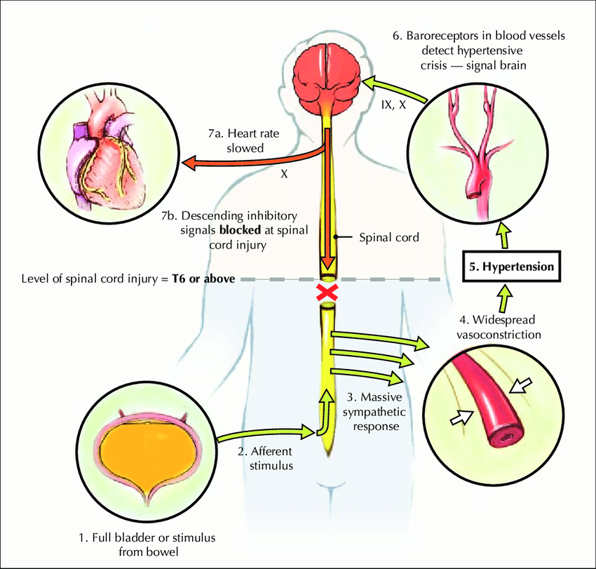 NeuroWalid's tweet image. #neurotip Autonomic dysreflexia occurs in acute spinal cord injuries at or above the T6 level. #spinalcord #neuroscience