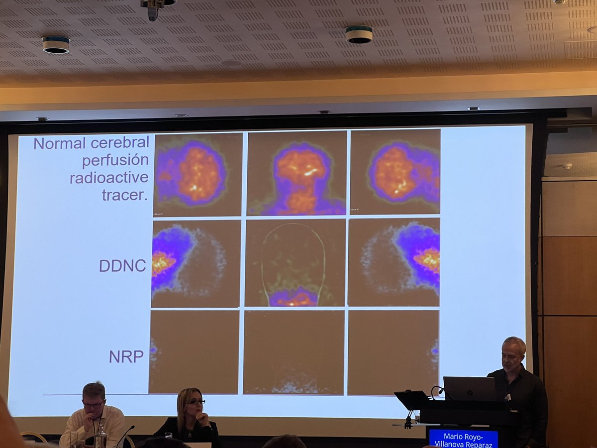 Irene (@dra_belloirene) on Twitter photo The way to follow: doubt about something, research and make conclusions. #TANRP and #NRP don’t restore brain perfusion. Great presentation and research line from #DrRoyoVillanova at #DCDcongress <a href="/ESOTtransplant/">ESOTtransplant</a> <a href="/SETrasplante/">SETrasplante</a> <a href="/ONT_esp/">Organización Nacional de Trasplantes</a> The way to follow: doubt about something, research and make conclusions. #TANRP and #NRP don’t restore brain perfusion. Great presentation and research line from #DrRoyoVillanova at #DCDcongress <a href="/ESOTtransplant/">ESOTtransplant</a> <a href="/SETrasplante/">SETrasplante</a> <a href="/ONT_esp/">Organización Nacional de Trasplantes</a>