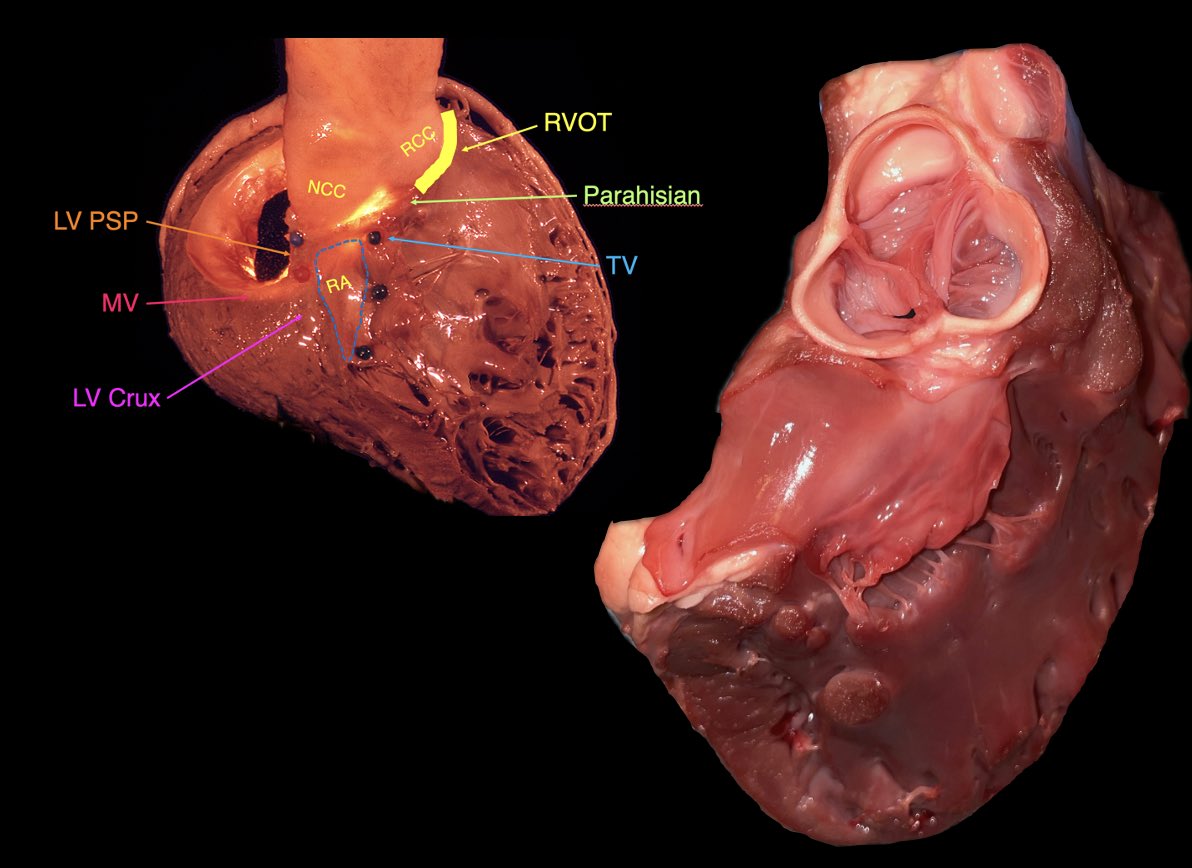 Fermin Carlos Garcia (@drfermingarcia) on Twitter photo Cardiac anatomy session with <a href="/PennEPFellows/">Penn Electrophysiology Fellowship</a> Fantastic evening dissecting into the heart structure and anatomical basics of EP procedures. <a href="/gsupple/">Greg Supple</a> <a href="/PennCardiology/">Penn Cardiology</a> Cardiac anatomy session with <a href="/PennEPFellows/">Penn Electrophysiology Fellowship</a> Fantastic evening dissecting into the heart structure and anatomical basics of EP procedures. <a href="/gsupple/">Greg Supple</a> <a href="/PennCardiology/">Penn Cardiology</a>