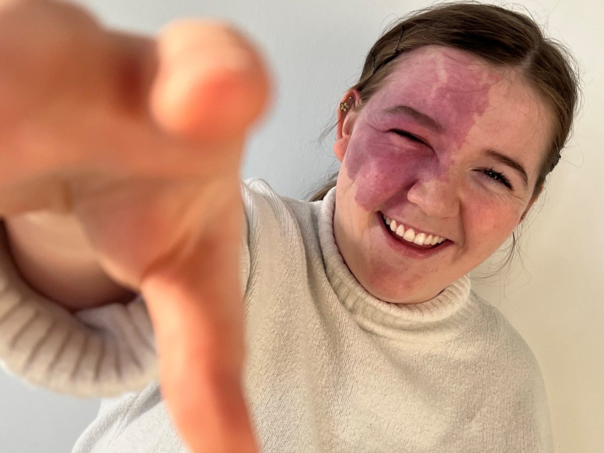 “In the future, I would love to see a focus on inclusion within education, raising an understanding from a young age that not everyone is born looking the same.”

While Evie has come to love her birthmark, she still find stares and comments hard to handle: ow.ly/P0GE50SJTS4