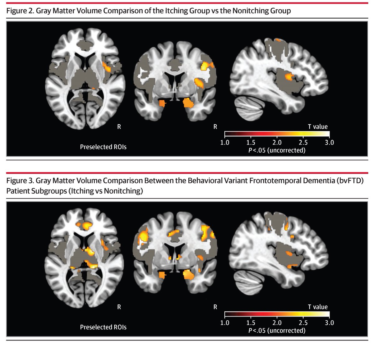Itching of undetermined origin may indicate the presence of a neurodegenerative process. In this study, a higher occurrence of itching was observed in patients with frontotemporal degeneration spectrum disorder compared with Alzheimer disease. ja.ma/4f2rVJL