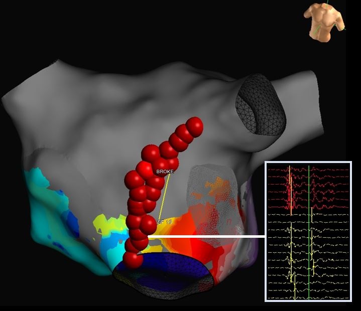 MaggieBinEP's tweet image. PFA PVI+Posterior Wall organized in 11-month persistent AFib into mitral annular flutter. Anterior mitral line beginning at the annulus terminated tachycardia where there was no voltage on #HDGrid, but perfectly lined up with #Abbott heat map. PFA Contact Matters.