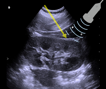 AvelRomanNeph's tweet photo. Otra técnica de BRP
Tecnica Tangencial Retrorrenal
Ventajas:
-Observas en todo momento el trayecto de la aguja
- Buena cantidad de glomérulos
-Alejado de Estructuras vasculares
#interventionalNephrology #INFellow #Kidneybiopsy https://t.co/5V8hqERRxa