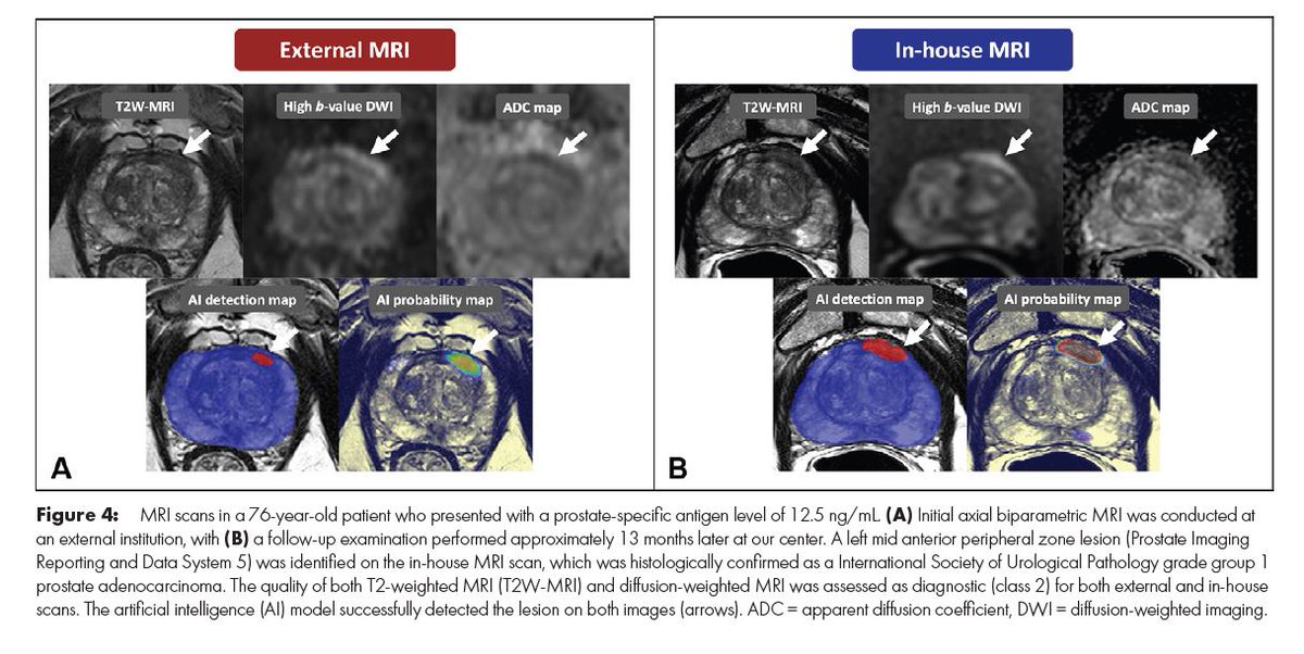 radiolobt's tweet photo. 📣Excited to share our latest publication "External Validation of a Deep Learning–based Prostate Lesion Detection Algorithm on Paired External and In-House Biparametric MRI Scans" 
🔵Huge congratulations to @eniscy and our amazing team for this important work which compared the performance of a publicly available #AI model's cancer detection performance on paired in-house (NCI) and external (private practice/community practice/academic centers) MRI data
Read more here: https://t.co/KSKAQ6oTD7
#prostatecancer #prostateMRI #ArtificialIntelligence #AI #cancerresearch #TeamScience