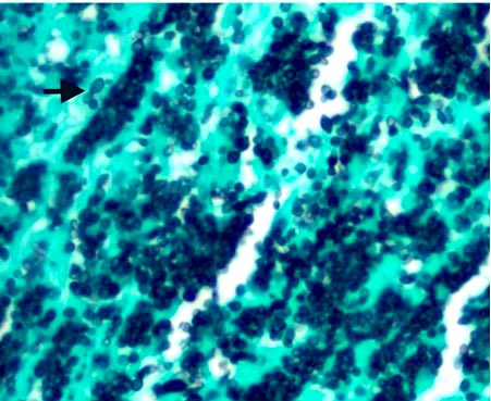 🦠 #FungusFriday: 
An immunocompromised patient presents with cough and shortness of breath, developed acute hypoxic respiratory failure. Endobronchial biopsy shows the following. 
Can you name the fungus? 🤔 #IDFellows #InfectiousDiseases #MedEd