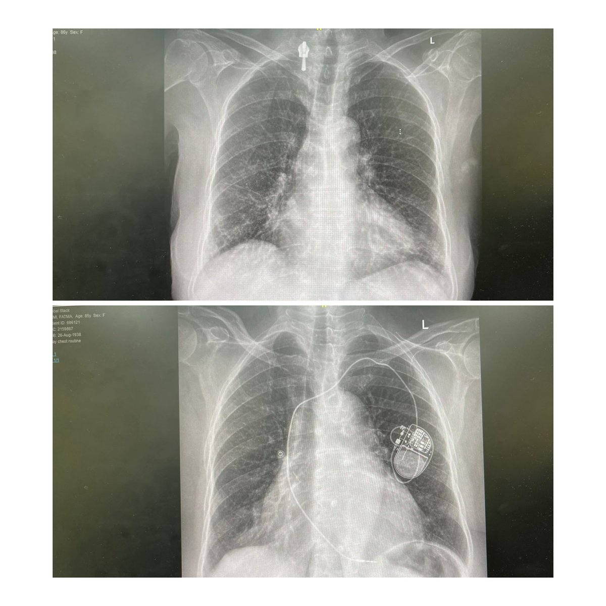 ⚠️ Shocking X-ray Mistake! Pacemaker Disappeared? 🫀🔍 
By <a href="/DrAsiriMohammad/">Mohammad I.Al-Assiri</a> 
A patient presented with chest pain, and we were shocked to find no pacemaker on the X-ray, despite one being implanted two months earlier. Upon review, it was discovered that a radiology technician had