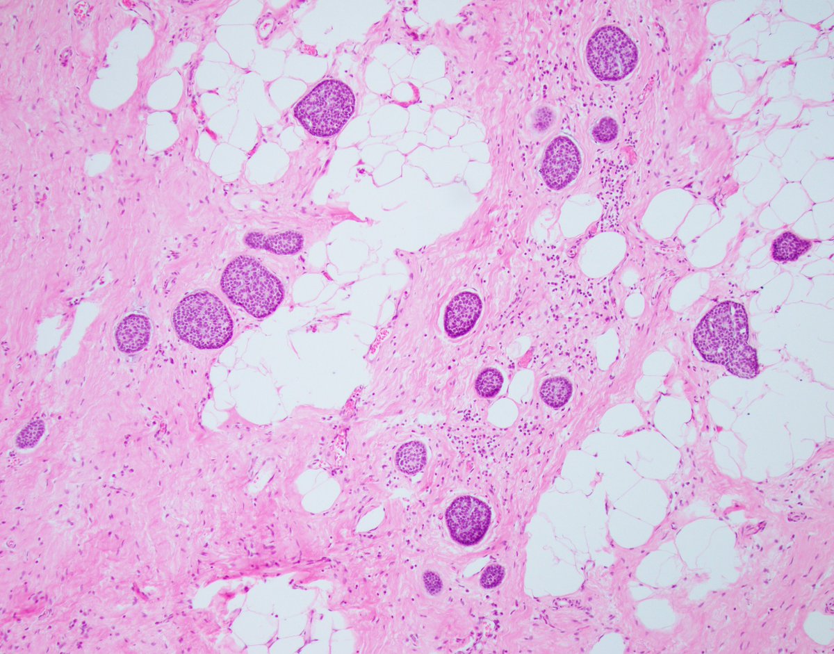 Fouad Boulos (@fouad_boulos) on Twitter photo Friday Fun!
Things are not always what they seem. What is your diagnosis?
#breastpath #PathTwitter #PathX <a href="/washu_pathology/">WashU Medicine Pathology & Immunology</a> <a href="/washupathedu/">WashU Medicine Pathology & Immunology Education</a> Friday Fun!
Things are not always what they seem. What is your diagnosis?
#breastpath #PathTwitter #PathX <a href="/washu_pathology/">WashU Medicine Pathology & Immunology</a> <a href="/washupathedu/">WashU Medicine Pathology & Immunology Education</a>