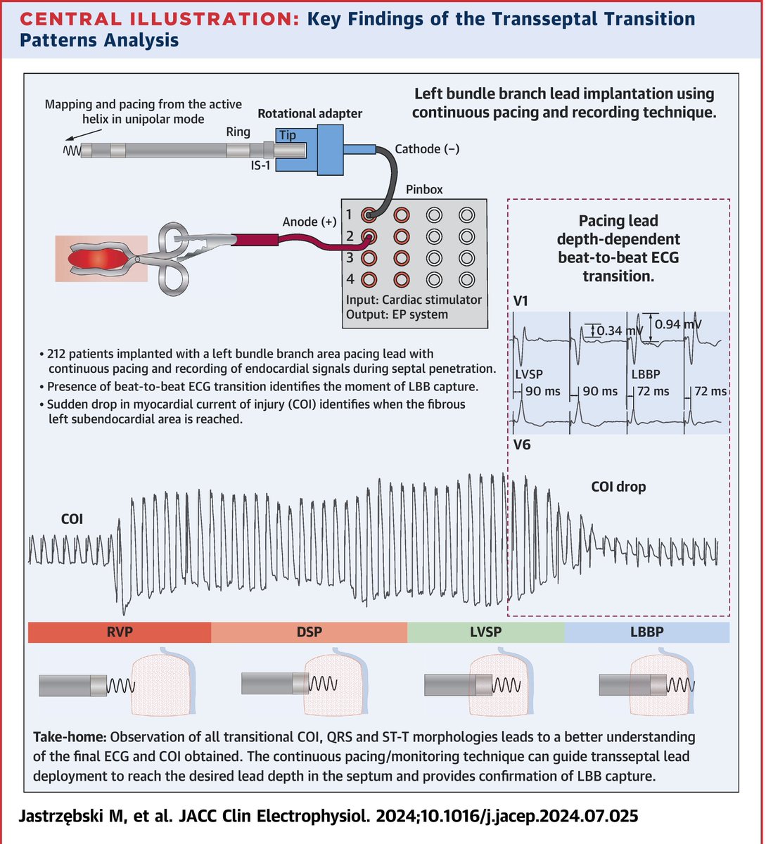 Marek Jastrzębski (@marek_jastrz_ep) on Twitter photo Transseptal Transition Patterns online! First delineation of COI amp. through septum; COI drop pattern; validation of lead depth-dependent V6RWPT shortening criterion, andmore! doi.10.1016.j.jacep.2024.07.025 <a href="/Hisdoc1/">Pugal Vijayaraman</a>
<a href="/HaranBurri/">Haran Burri</a>
<a href="/kvernooy/">Kevin Vernooy</a>
<a href="/curilakarol/">curilakarol</a>
<a href="/OCanoPerez/">Óscar Cano</a>
#dontdisthehis Transseptal Transition Patterns online! First delineation of COI amp. through septum; COI drop pattern; validation of lead depth-dependent V6RWPT shortening criterion, andmore! doi.10.1016.j.jacep.2024.07.025 <a href="/Hisdoc1/">Pugal Vijayaraman</a>
<a href="/HaranBurri/">Haran Burri</a>
<a href="/kvernooy/">Kevin Vernooy</a>
<a href="/curilakarol/">curilakarol</a>
<a href="/OCanoPerez/">Óscar Cano</a>
#dontdisthehis