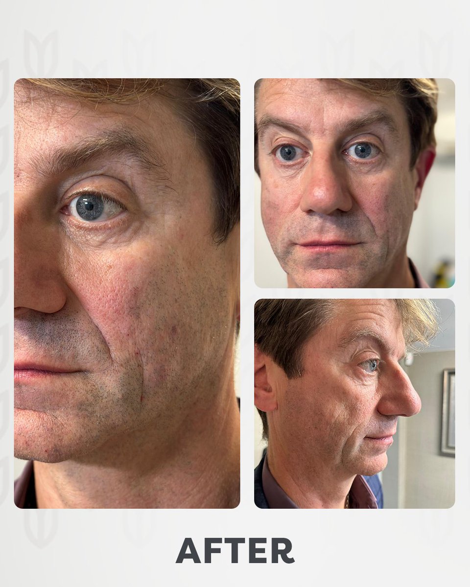 Facial and profile balancing for a refreshed and natural look! ✨
With subtle enhancements, we bring balance and harmony to the face, restoring confidence and youthfulness.
The beauty of non-surgical treatments lies in the natural, yet impactful results. 💉