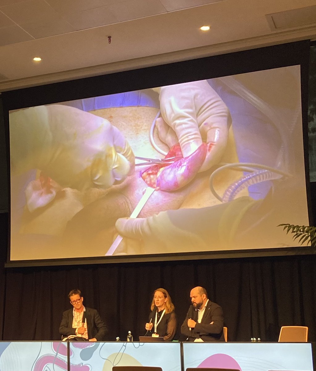 Izzie Dighero (@isabeldijeroo) on Twitter photo Fantastic few days in Antwerp <a href="/Uroweb/">European Association of Urology (EAU)</a> andrology! A privilege to present the work undertaken <a href="/uclh/">UCLH</a> by andrology superwoman <a href="/Pippa_Sangster/">Pippa Sangster</a>. When optimising infertile males with varicocele - embolisation is not inferior! Fantastic few days in Antwerp <a href="/Uroweb/">European Association of Urology (EAU)</a> andrology! A privilege to present the work undertaken <a href="/uclh/">UCLH</a> by andrology superwoman <a href="/Pippa_Sangster/">Pippa Sangster</a>. When optimising infertile males with varicocele - embolisation is not inferior!