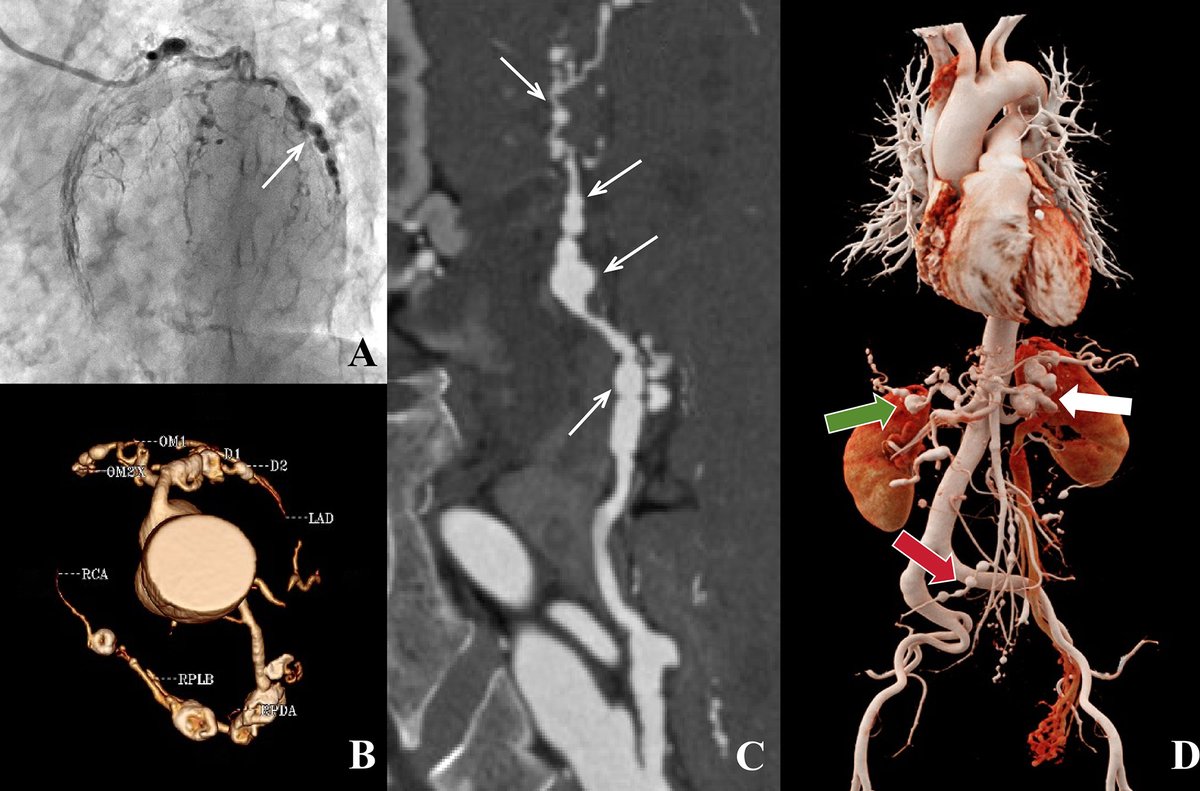 🩺Check out our latest Images in Radiology article on multifocal fibromuscular dysplasia involving the coronary arteries! Discover key insights and imaging findings that enhance understanding of this condition. Don’t miss it! #Radiology #Cardiology
pubs.rsna.org/doi/10.1148/ra…