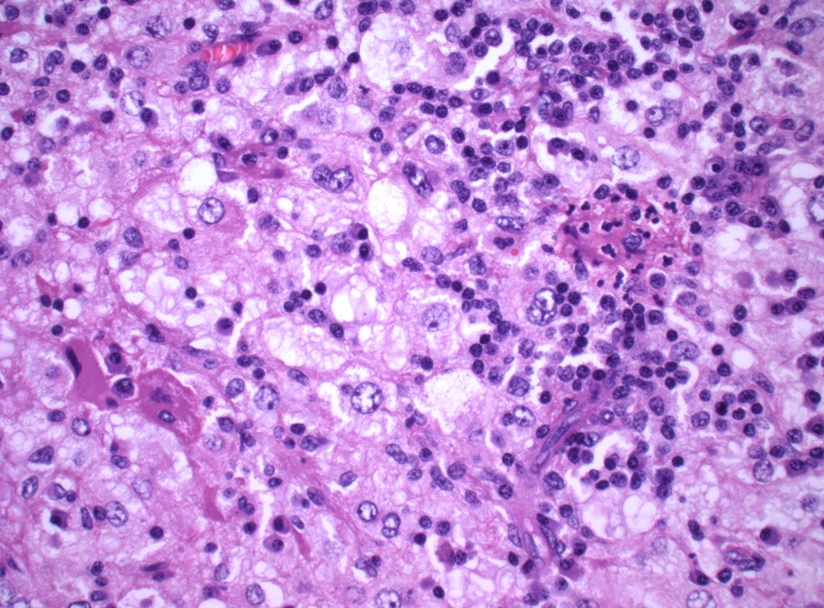 DanGrahamMD's tweet photo. 30s F abdominal wall mass. IHC? Dx?

#PathTwitter #PathX https://t.co/x5LtpiiEhh