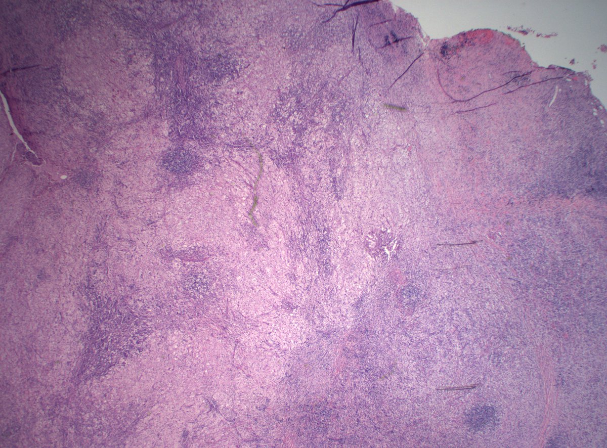 DanGrahamMD's tweet photo. 30s F abdominal wall mass. IHC? Dx?

#PathTwitter #PathX https://t.co/x5LtpiiEhh