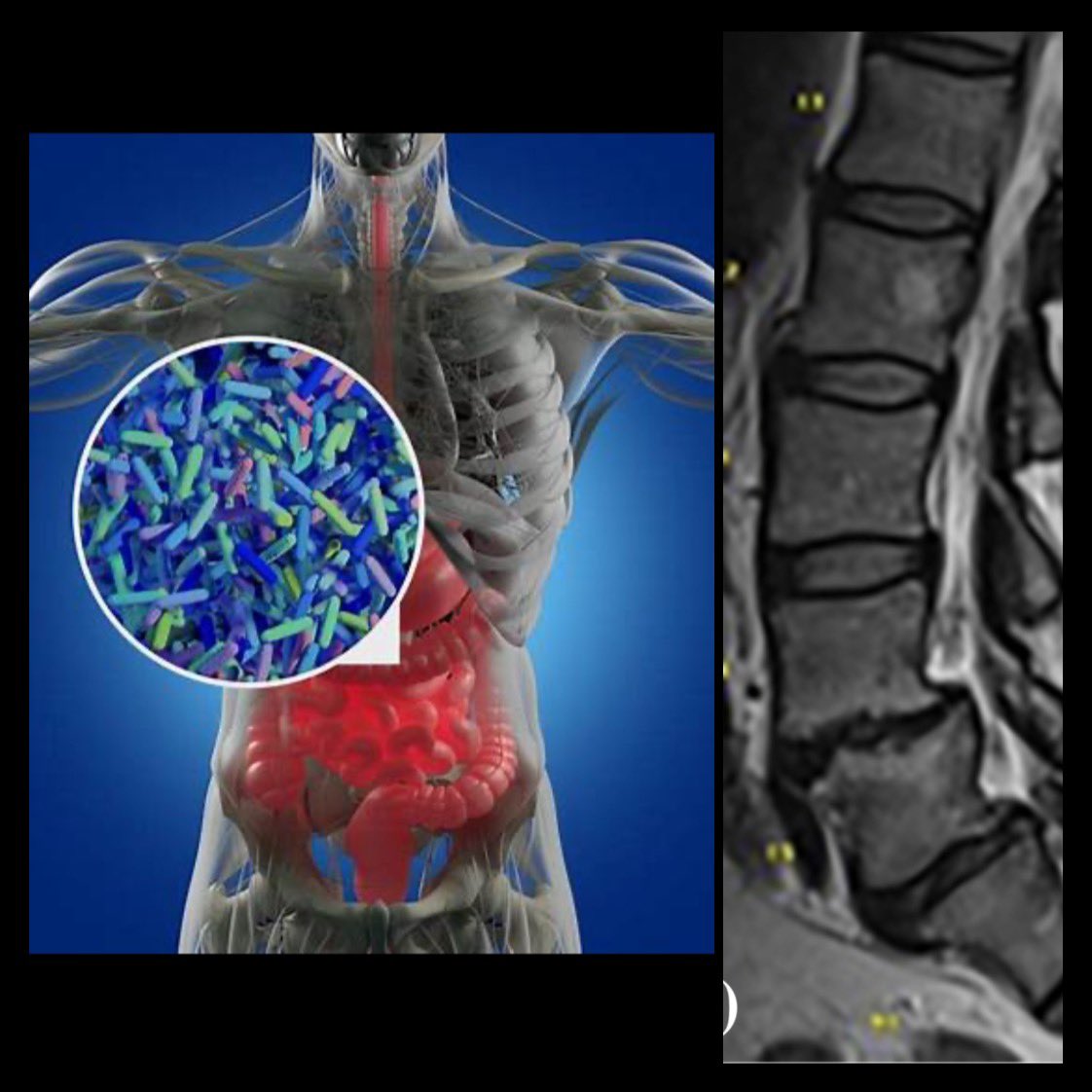 Spine Research - RUSH University (@isriirush) on Twitter photo Can bacteria in your gut lead to back pain?
Researchers at <a href="/RUOrthoResearch/">RUSH Orthopedic Research</a> have discovered for the first time that an unhealthy gut #microbiome that promotes inflammatory bacteria may lead to painful spine conditions necessitating #surgery.
onlinelibrary.wiley.com/doi/full/10.10… Can bacteria in your gut lead to back pain?
Researchers at <a href="/RUOrthoResearch/">RUSH Orthopedic Research</a> have discovered for the first time that an unhealthy gut #microbiome that promotes inflammatory bacteria may lead to painful spine conditions necessitating #surgery.
onlinelibrary.wiley.com/doi/full/10.10…