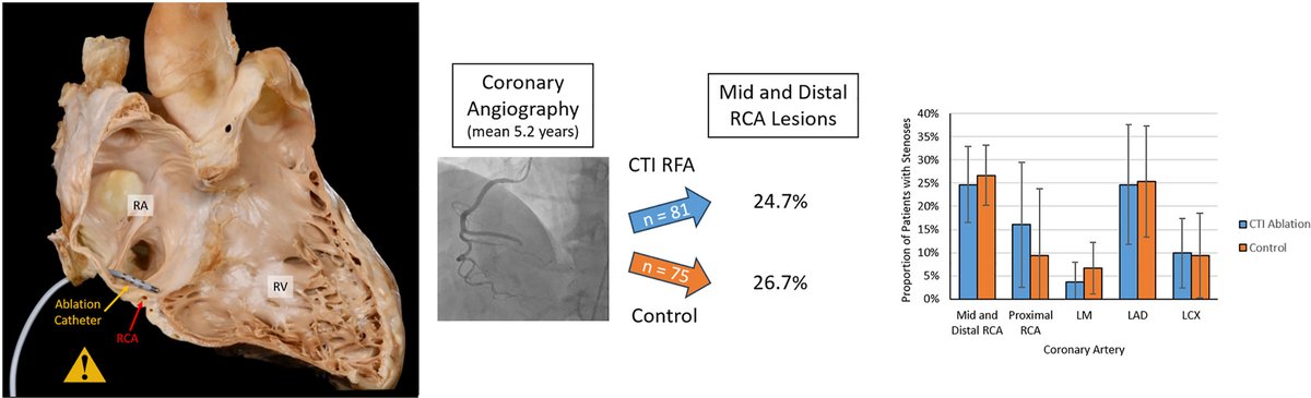 Matthew Hyman (@drmatthewhyman) on Twitter photo #EPeeps Have you ever worried about long-term RCA damage following cavotricuspid isthmus radiofrequency ablation? Check out our recent study in <a href="/hrs_journal/">HeartRhythm</a>
kwnsfk27.r.eu-west-1.awstrack.me/L0/https:%2F%2… #EPeeps Have you ever worried about long-term RCA damage following cavotricuspid isthmus radiofrequency ablation? Check out our recent study in <a href="/hrs_journal/">HeartRhythm</a>
kwnsfk27.r.eu-west-1.awstrack.me/L0/https:%2F%2…