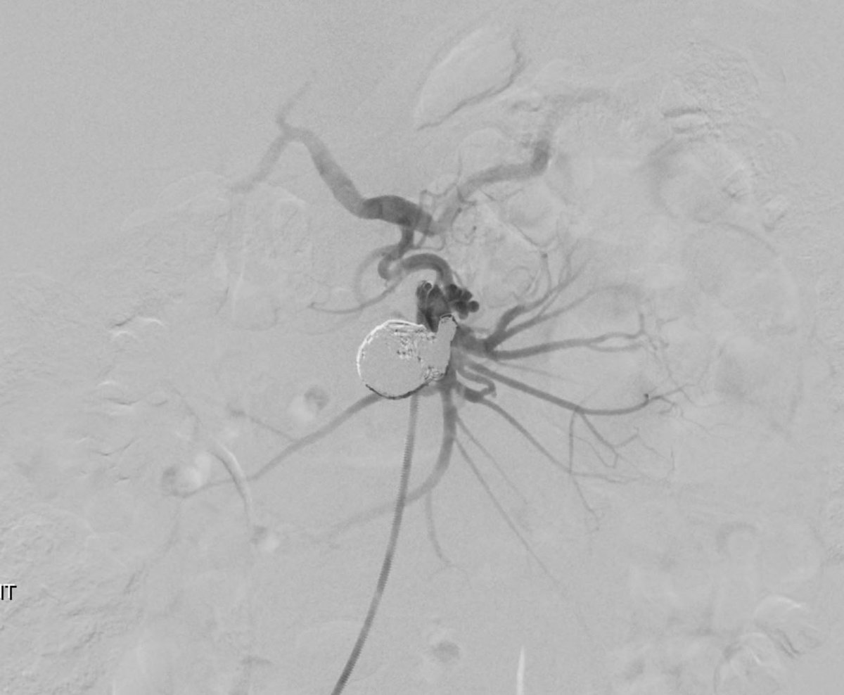 Nass_the_gr8's tweet photo. Median arcuate ligament (MAL) compression with 2.9 cm IPDA aneurysm. Embolization carried out with #embold detachable coils. Celiac axis reconstituted distal to its origin by a patent Arc of Buhler #irad https://t.co/cUFvcoqWt7