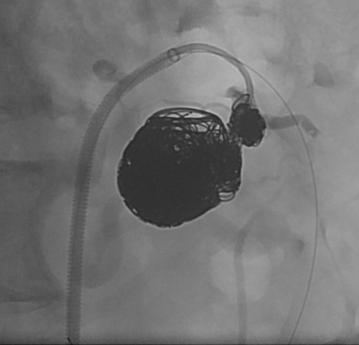 Nass_the_gr8's tweet photo. Median arcuate ligament (MAL) compression with 2.9 cm IPDA aneurysm. Embolization carried out with #embold detachable coils. Celiac axis reconstituted distal to its origin by a patent Arc of Buhler #irad https://t.co/cUFvcoqWt7