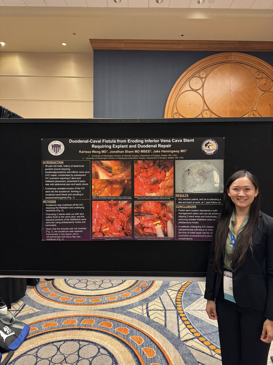 Jake Hemingway (@jfhemingway) on Twitter photo Karissa Wang PGY-1 <a href="/UWVascsurg/">UW Vascular</a> Vascular Resident here at AVLS presenting an interesting case: duodenal-caval fistula resulting from an eroding IVC stent…great case! Karissa Wang PGY-1 <a href="/UWVascsurg/">UW Vascular</a> Vascular Resident here at AVLS presenting an interesting case: duodenal-caval fistula resulting from an eroding IVC stent…great case!