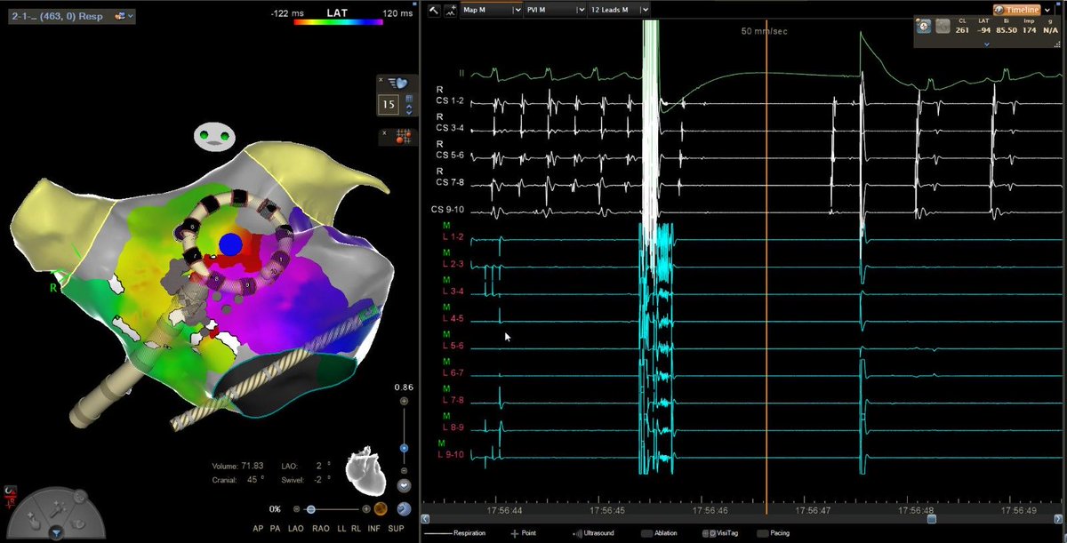 GustavoRRodrigues (@life_activist_) on Twitter photo Atypical flutter mapping and ablation with Varipulse catheter & Truepulse!! <a href="/cgmarinescu/">Cătălin Marinescu</a> <a href="/JoanaPinho92/">Joana Pinho</a> <a href="/jjmt_ep/">Johnson & Johnson MedTech | Electrophysiology</a> <a href="/gmoraisflor/">Guilherme Flor</a> #CheilaThompson #PAdragão | HospitalSantaCruz Atypical flutter mapping and ablation with Varipulse catheter & Truepulse!! <a href="/cgmarinescu/">Cătălin Marinescu</a> <a href="/JoanaPinho92/">Joana Pinho</a> <a href="/jjmt_ep/">Johnson & Johnson MedTech | Electrophysiology</a> <a href="/gmoraisflor/">Guilherme Flor</a> #CheilaThompson #PAdragão | HospitalSantaCruz
