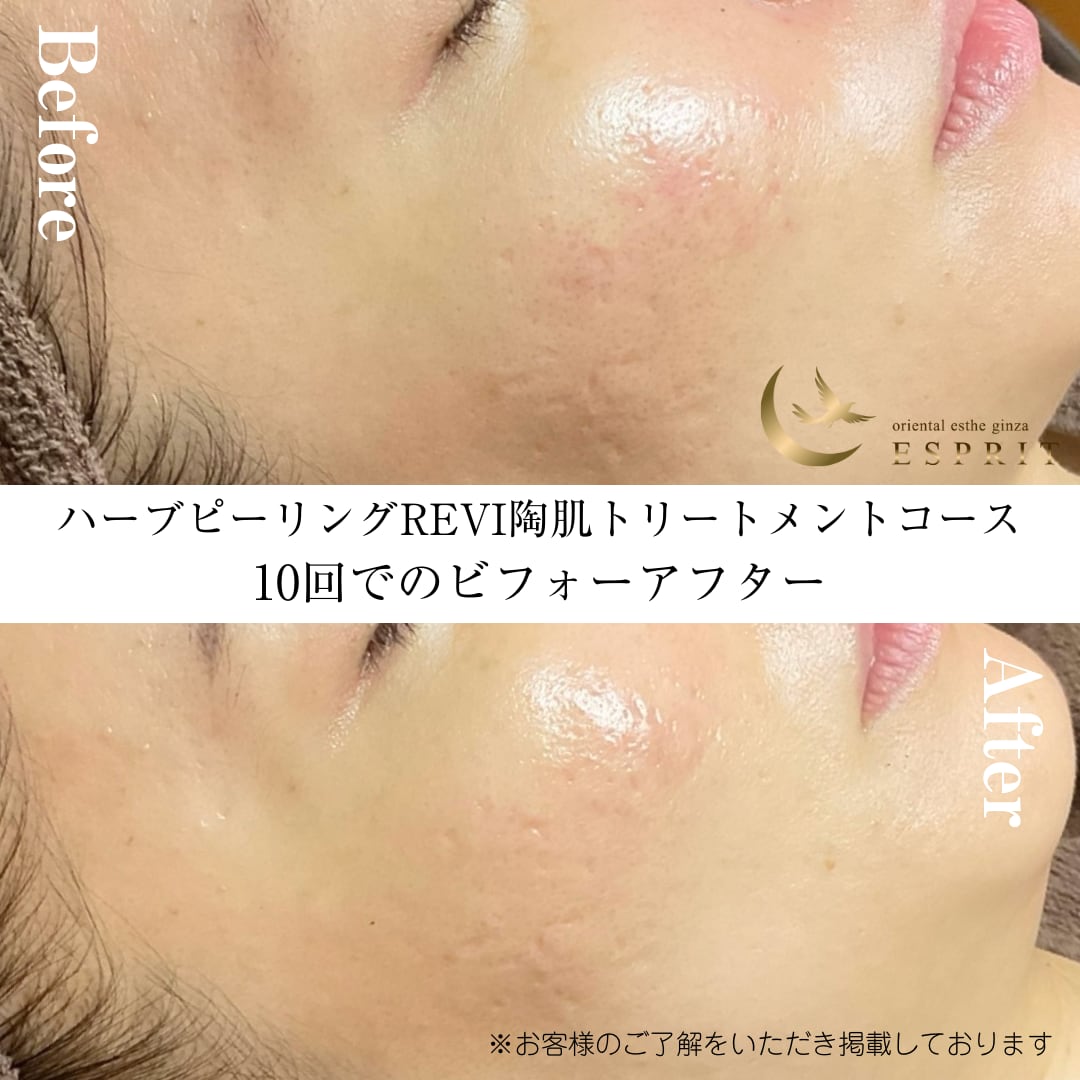 5回分REVIハーブピーリング 超お得◎】今だけ限定価格！REVIハーブピーリングセット5回分