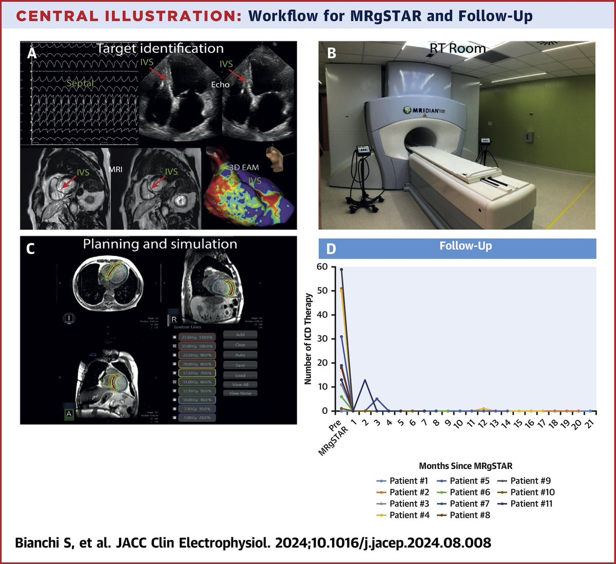 Michele Magnocavallo (@michelefg91) on Twitter photo Magnetic guided Radiotherapy for the treatment of septal VT. Significant decrease in VT burden and no AV block.
Our experience on <a href="/JACCJournals/">JACC Journals</a>
jacc.org/doi/10.1016/j.… Magnetic guided Radiotherapy for the treatment of septal VT. Significant decrease in VT burden and no AV block.
Our experience on <a href="/JACCJournals/">JACC Journals</a>
jacc.org/doi/10.1016/j.…