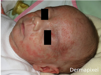 SCPed's tweet photo. 🧐"Un bebé con granos en la cara", cas de dermatologia pediàtrica al blog #Dermapixel de @rosataberner https://t.co/lkAKBVJNAg https://t.co/4l2BBIzAcs