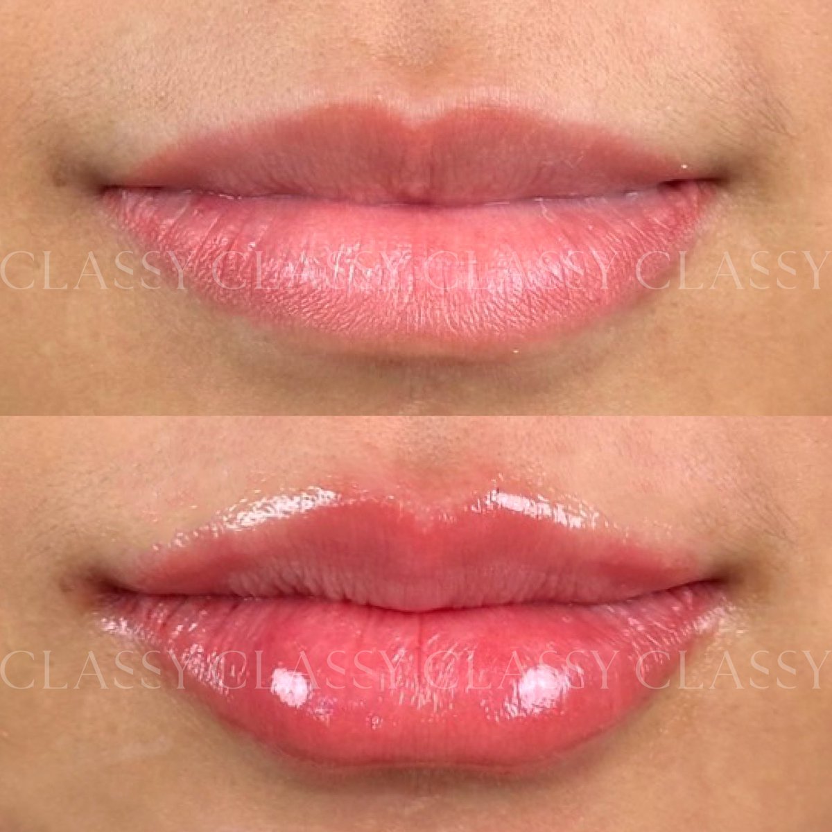 ClassyClinic's tweet photo. ทรงปากสวยจึ้ง เชอร์รี่ที่ถูกต้อง!! ✨🍒

#fillerlips #ClassyLips #ClassyClinic https://t.co/eUsahUWcRc
