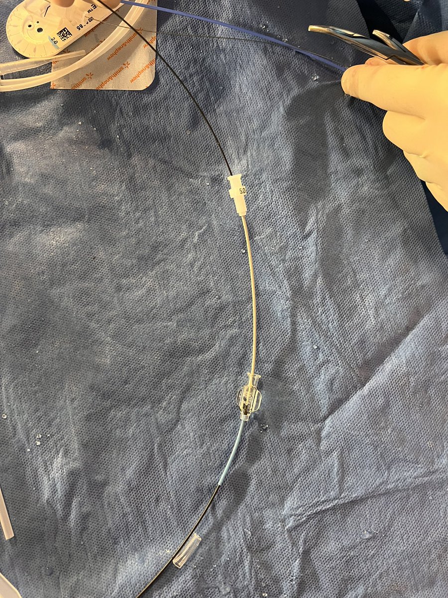 Harris Chengazi (@chengazimd) on Twitter photo #VIRad is the #MacGuyver specialty.
I know I could have just opened a longer wire, but already had two short ones and a micro kit open.
Used this technique to extend a 75cm amplatz to allow catheter exchange for APDL without losing access into a transplant kidney. <a href="/_backtable/">BackTable Vascular and Interventional</a> #VIRad is the #MacGuyver specialty.
I know I could have just opened a longer wire, but already had two short ones and a micro kit open.
Used this technique to extend a 75cm amplatz to allow catheter exchange for APDL without losing access into a transplant kidney. <a href="/_backtable/">BackTable Vascular and Interventional</a>